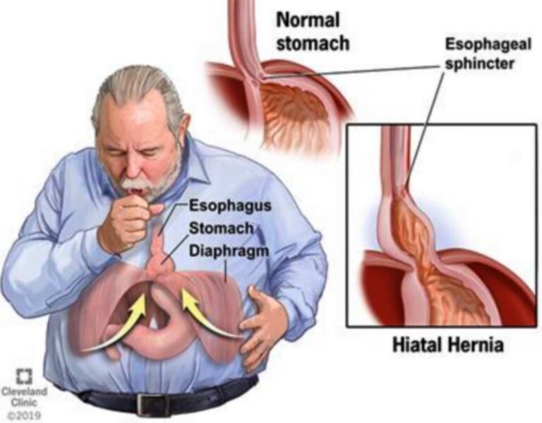Ernia iatale: sintomi, cause scatenanti e cura